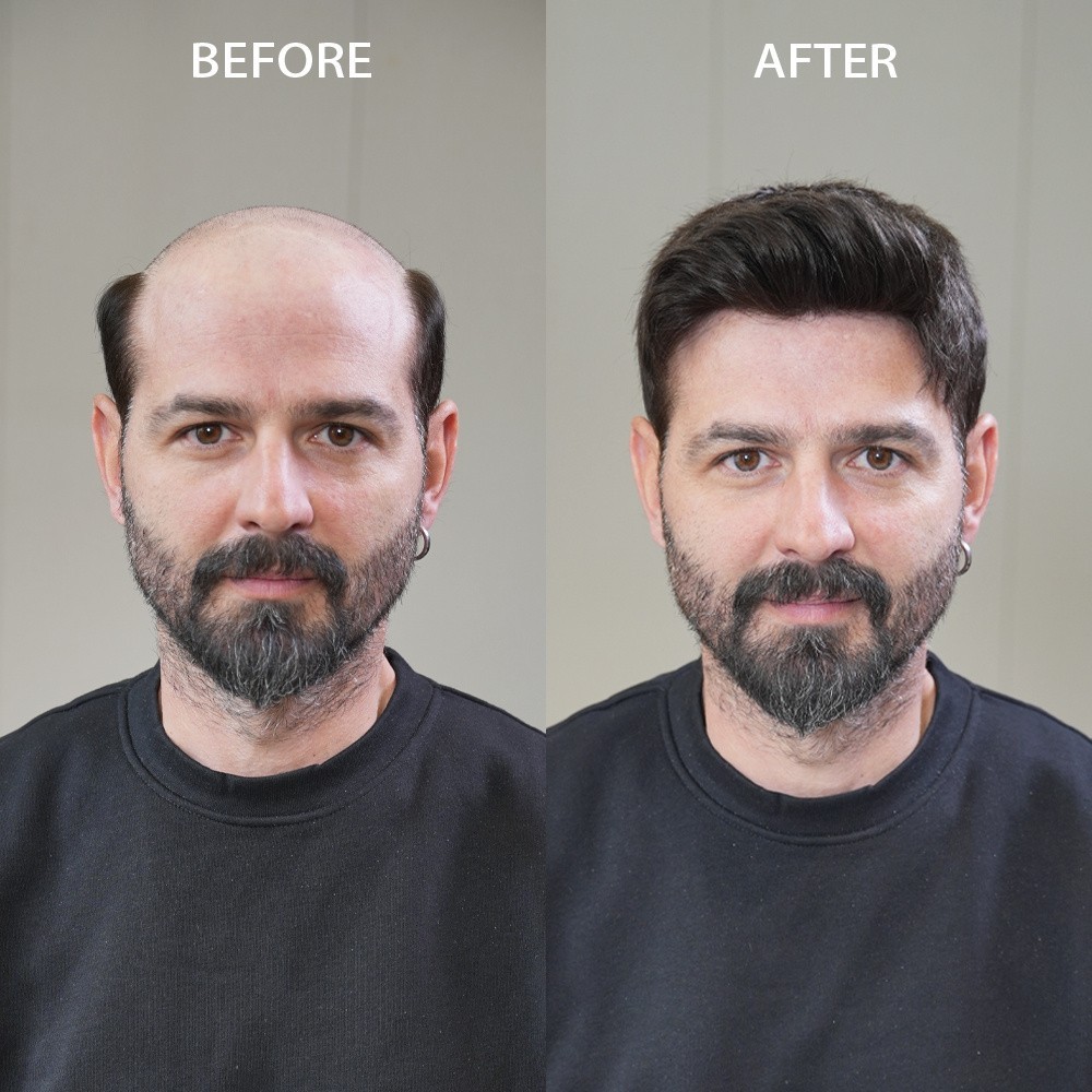 Full Poly Skin Mens Toupee Injected PU Human Hair System Replacement Wig for Men