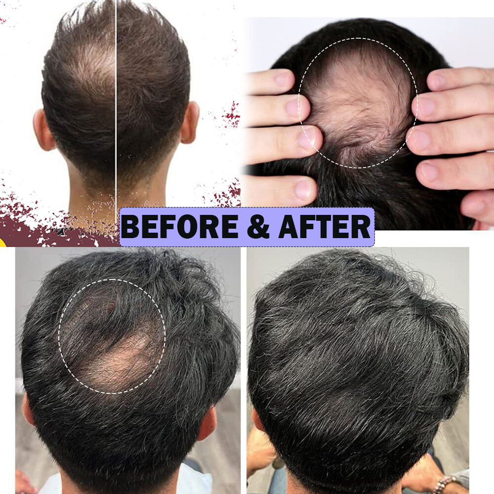 Full PU Bald Spot Remy Human Hair Cover-up Hair Patches Head Top Replacement 8*8