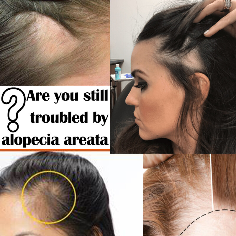 Human Hair Patch Full Lace Cover-up Topper Hairpiece for Women’s Alopecia Areata