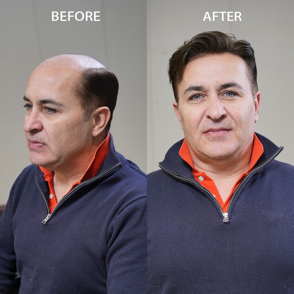 Full Poly Skin Mens Toupee Injected PU Human Hair System Replacement Wig for Men